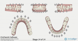 Clinical check results showing my teeth after invisalign treatment