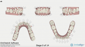 Clinical check results showing my teeth before invisalign